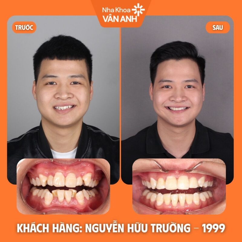 NIỀNG RĂNG NHA KHOA VÂN ANH
