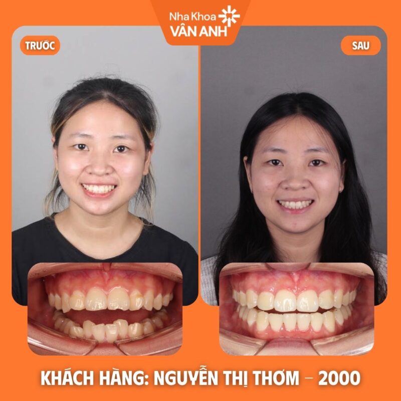 NIỀNG RĂNG NHA KHOA VÂN ANH