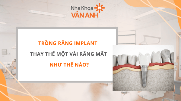 TRỒNG RĂNG IMPLANT THAY THẾ MỘT VÀI RĂNG MẤT