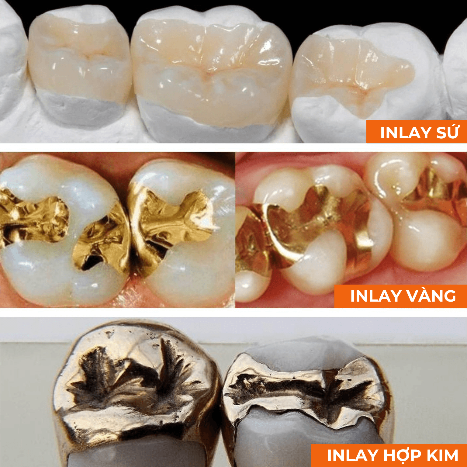 Ưu Và Nhược Điểm Của Inlay - Nha khoa Vân Anh
