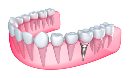 trồng răng implant là gì