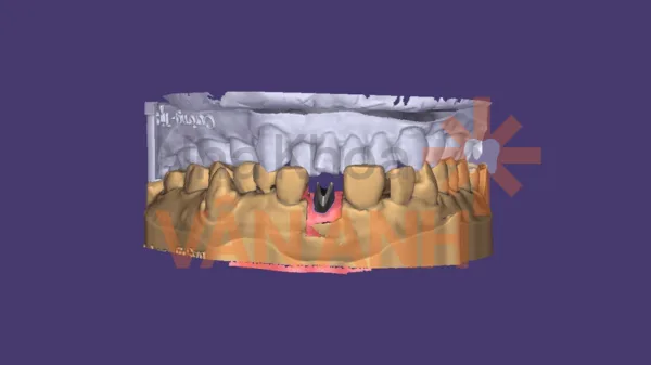 abutment cá nhân hóa