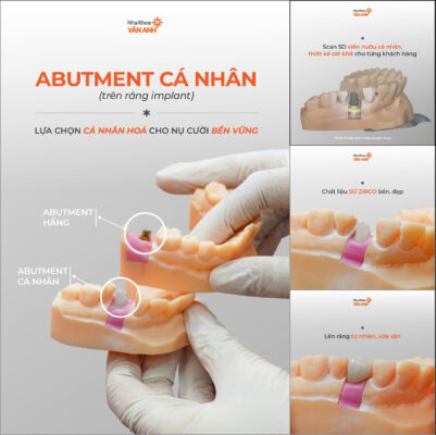 abutment cá nhân hóa