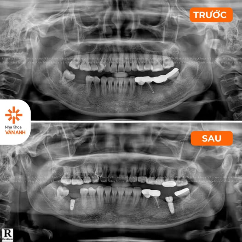 TRỒNG RĂNG IMPLANT RĂNG HÀM