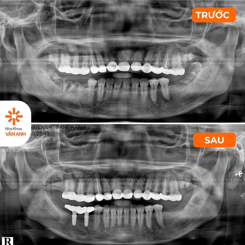 TRỒNG RĂNG IMPLANT RĂNG HÀM