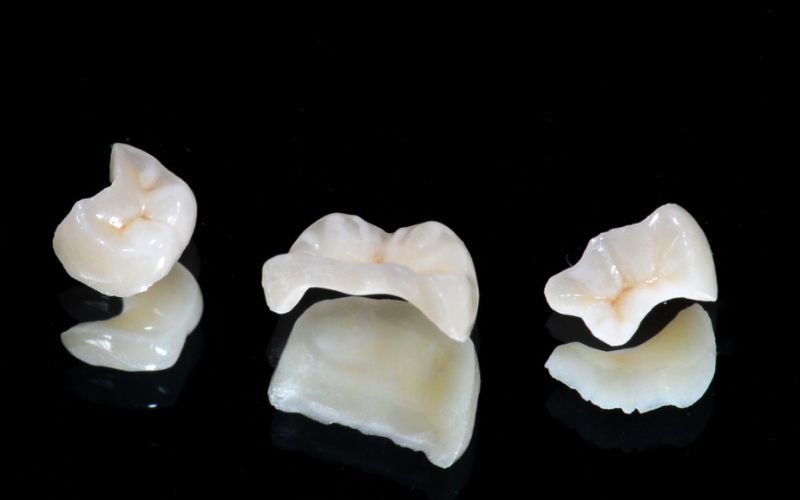 Teslin Inlay Quy Trình Chi Tiết Làm Inlay Trong Nha Khoa - Nha khoa Vân Anh