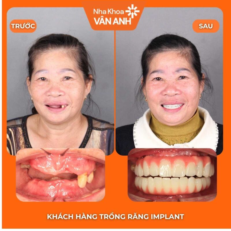 trồng răng implant nha khoa vân anh (1)