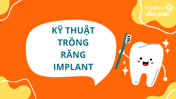 Kỹ thuật trồng răng implant