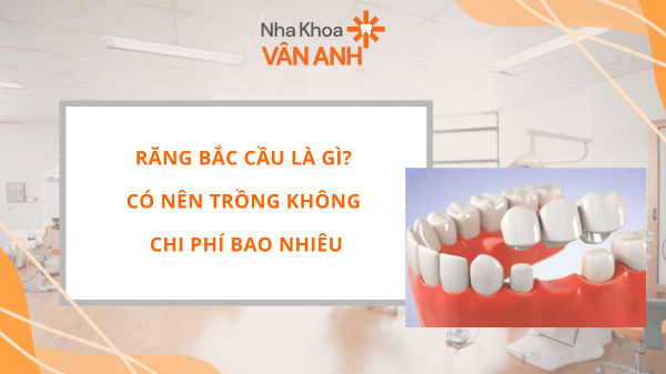 Răng bắc cầu là gì