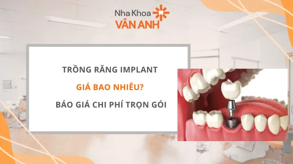 Trồng răng implant giá bao nhiêu