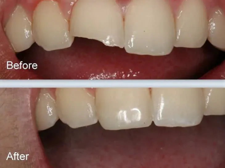 trám răng cửa bị mẻ