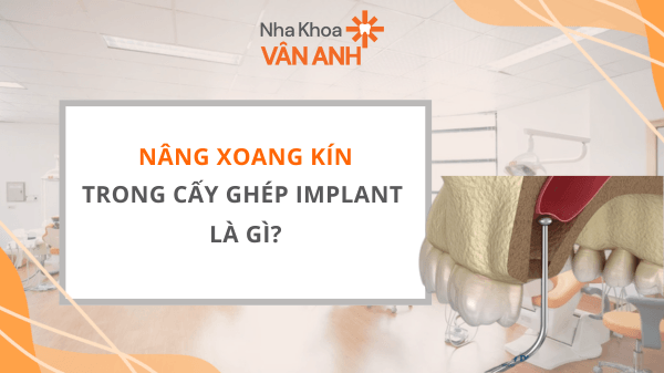 Nâng Xoang Kín Trong Cấy Ghép Implant Là Gì