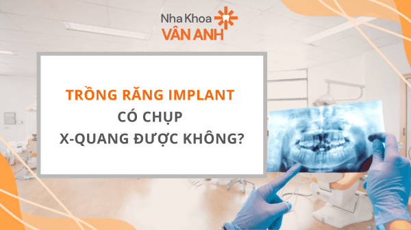 Trồng răng Implant có chụp X-quang được không