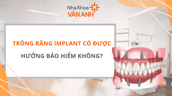 Trồng răng Implant có được hưởng bảo hiểm không