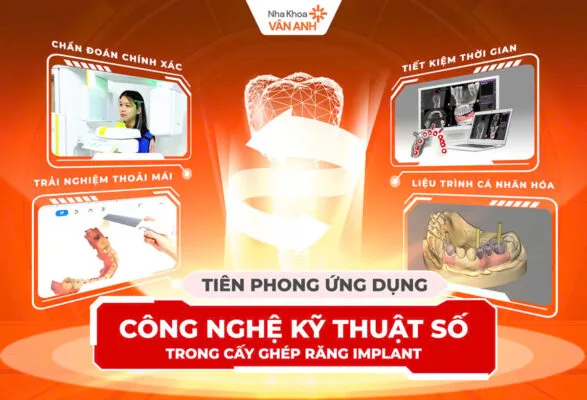 trồng răng implant kỹ thuật số