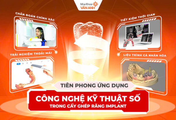 trồng răng implant kỹ thuật số