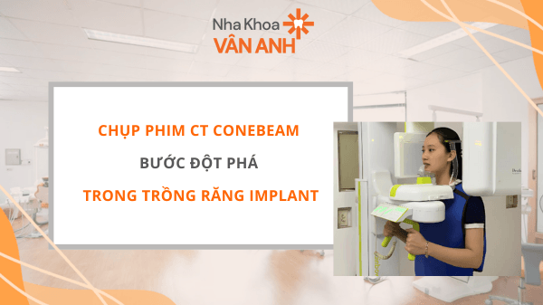 Chụp phim CT Conebeam