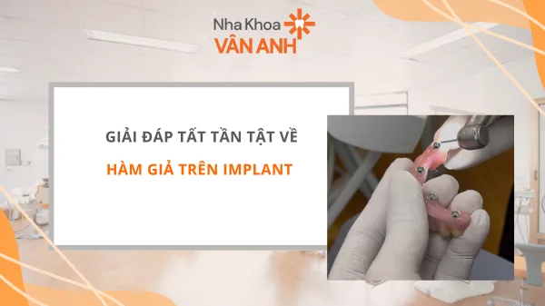 HÀM GIẢ TRÊN IMPLANT