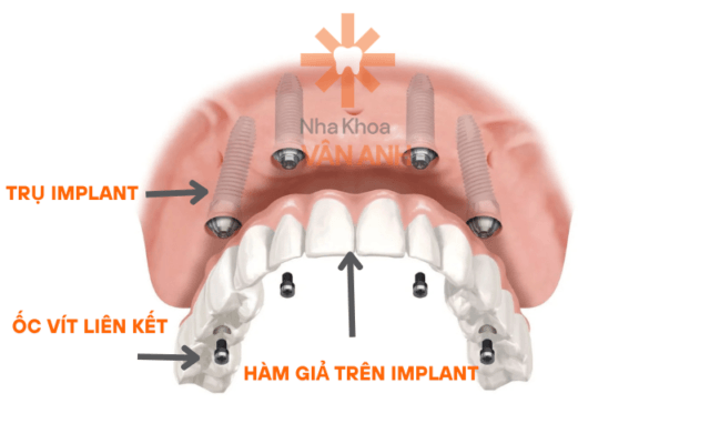 HÀM GIẢ TRÊN IMPLANT 
