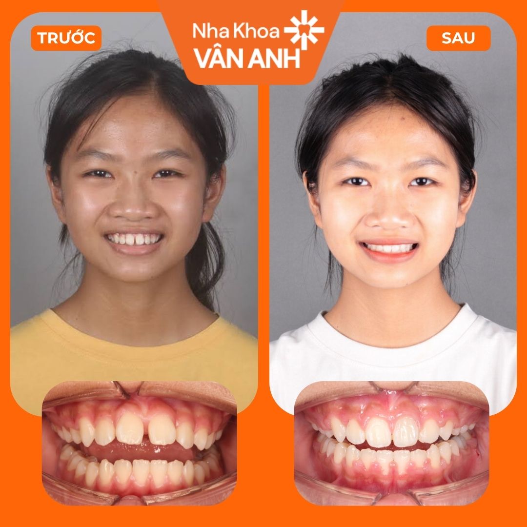 KH NIỀNG RĂNG (6)