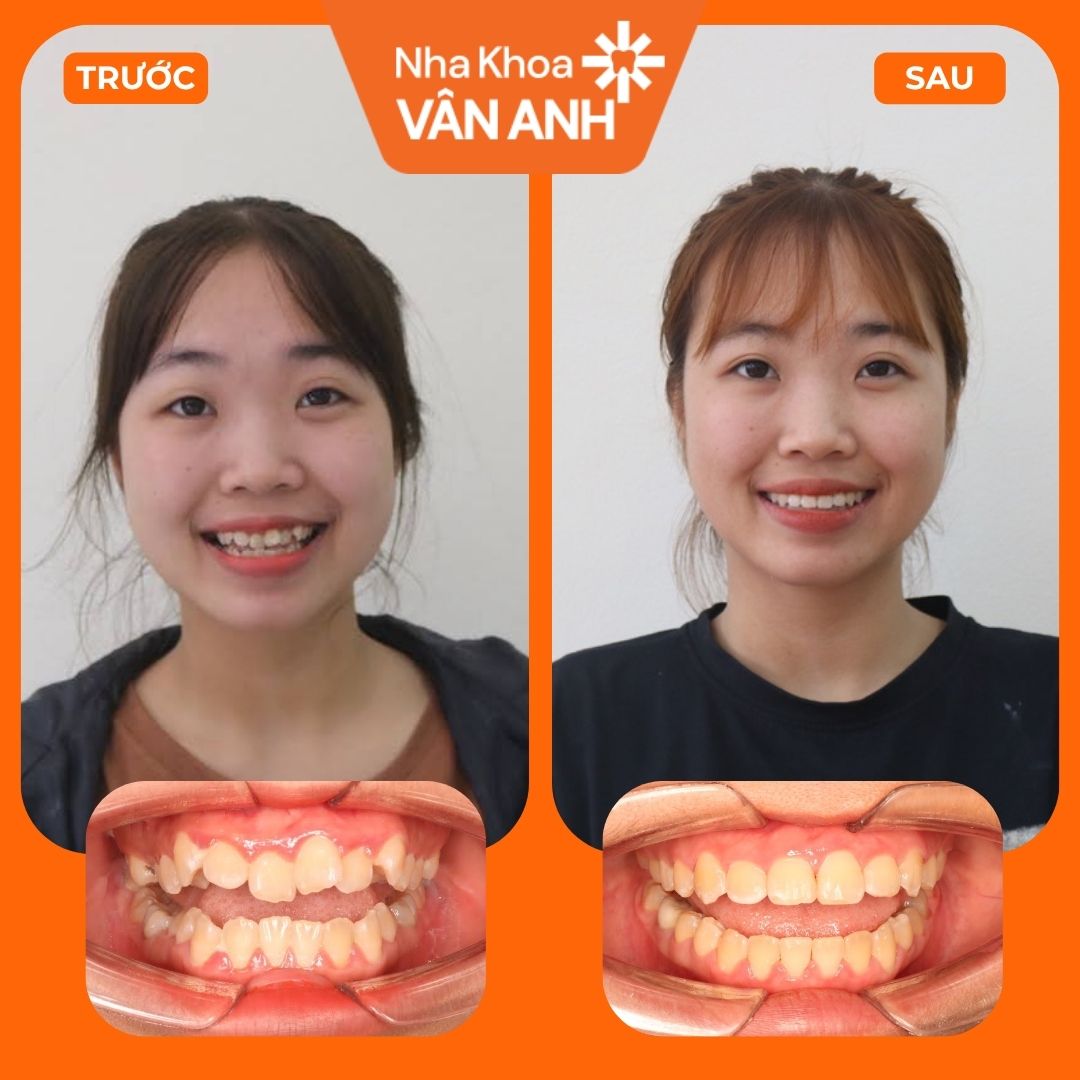 KH NIỀNG RĂNG (7)