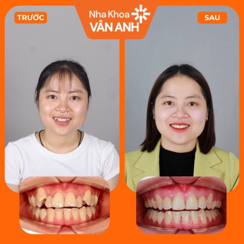 KH NIỀNG RĂNG (8)