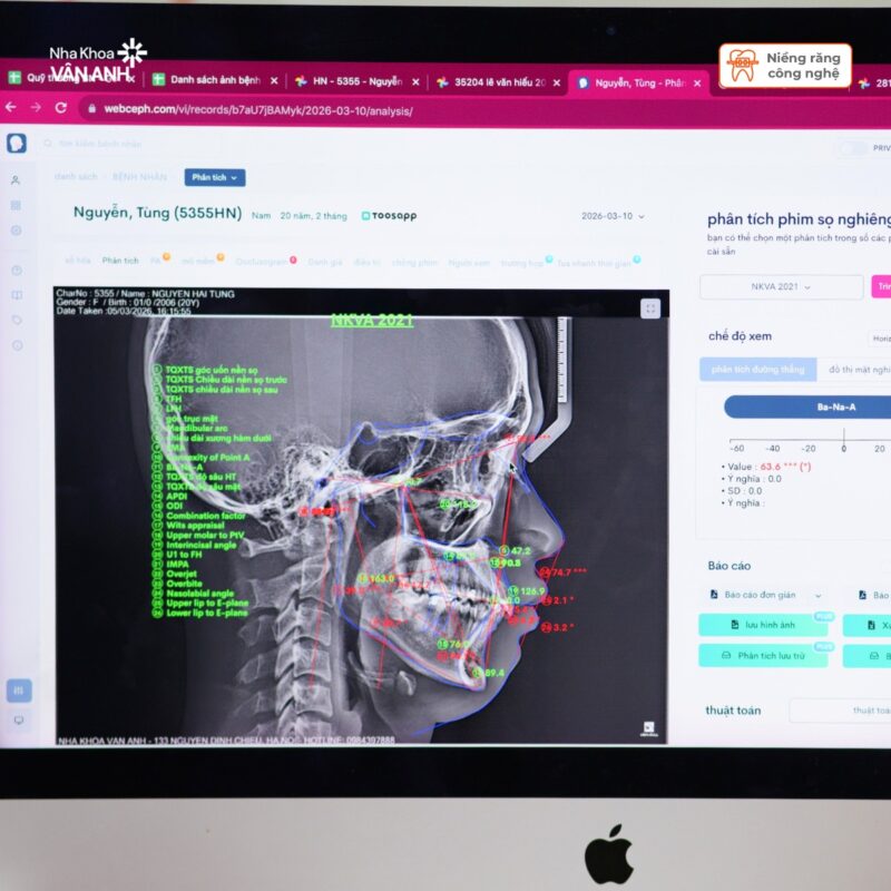 tư vấn niềng răng nha khoa vân anh 2