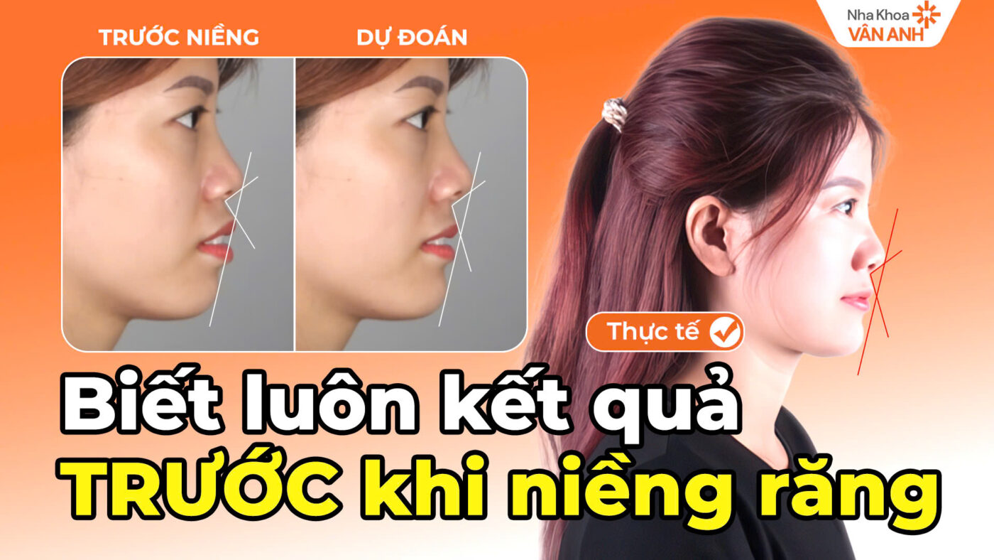 biết trước kết quả niềng răng