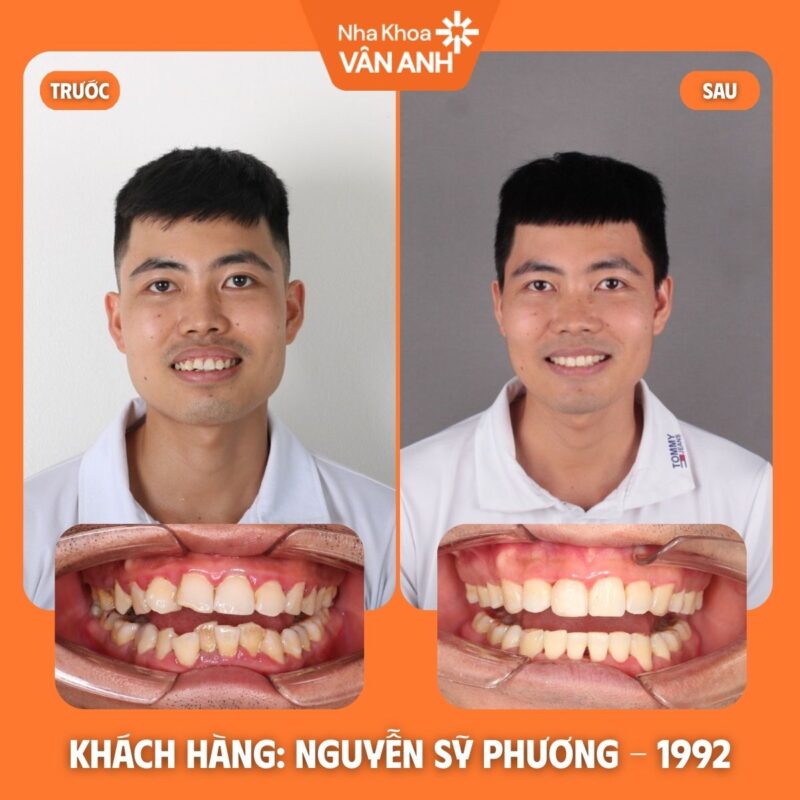 KH NIỀNG RĂNG