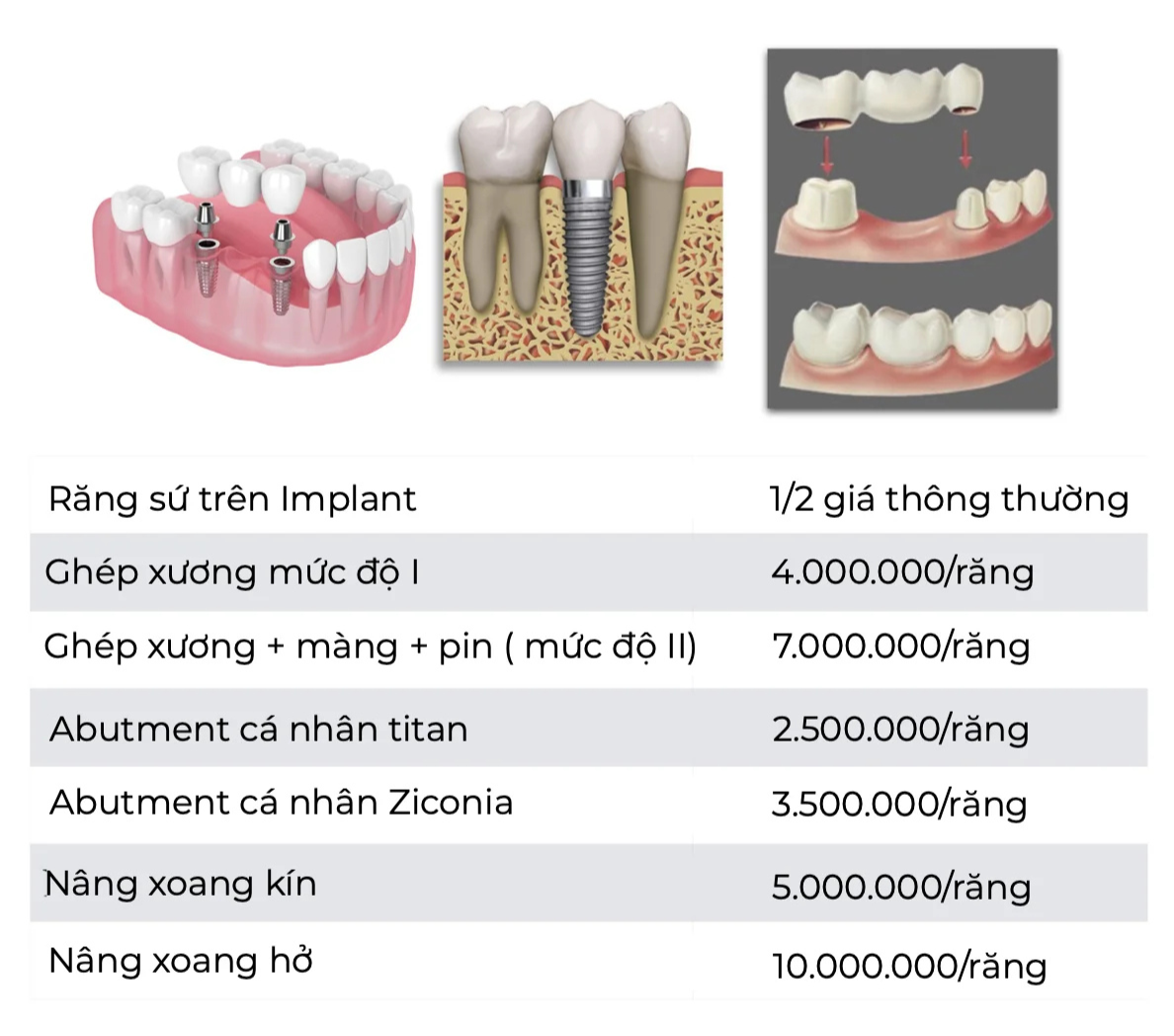bảng giá nâng xoang ghép xương implant