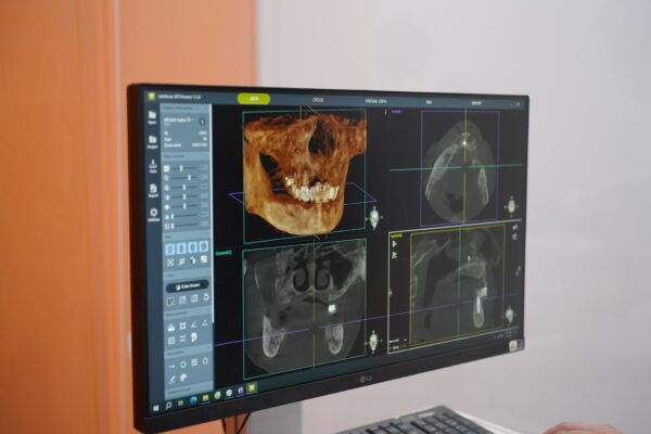 chụp phim ct conebeam