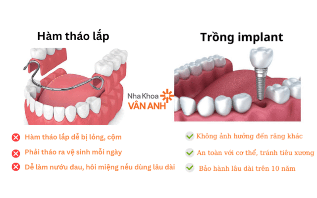 so sánh hàm tháo lắp và trồng răng implant