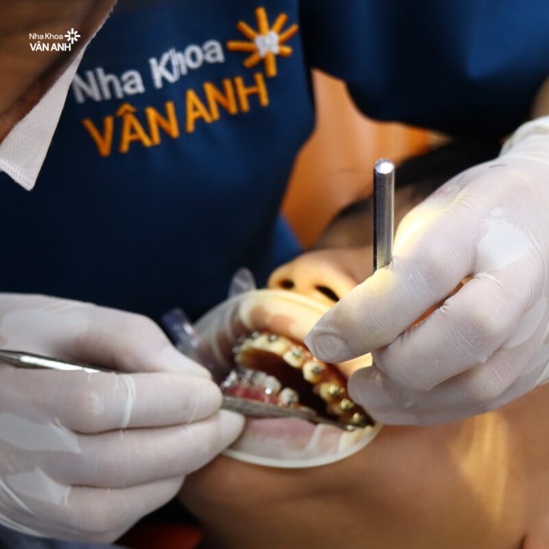 niềng răng nha khoa vân anh