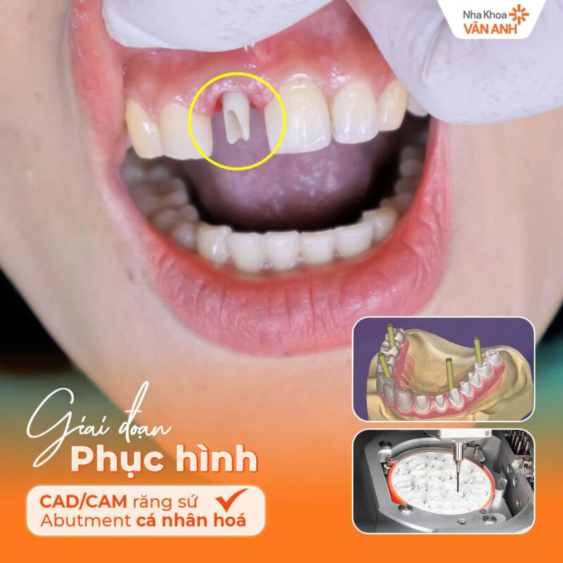 trồng răng ở hải dương