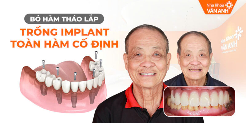 trồng răng implant thay thế hàm giả tháo lắp