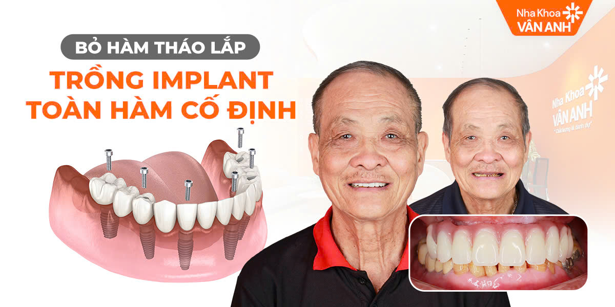 Trồng răng Implant toàn hàm