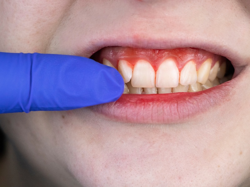 bọc răng sứ bị chảy máu