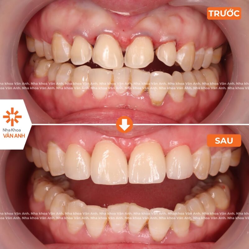 bọc răng sứ nha khoa vân anh