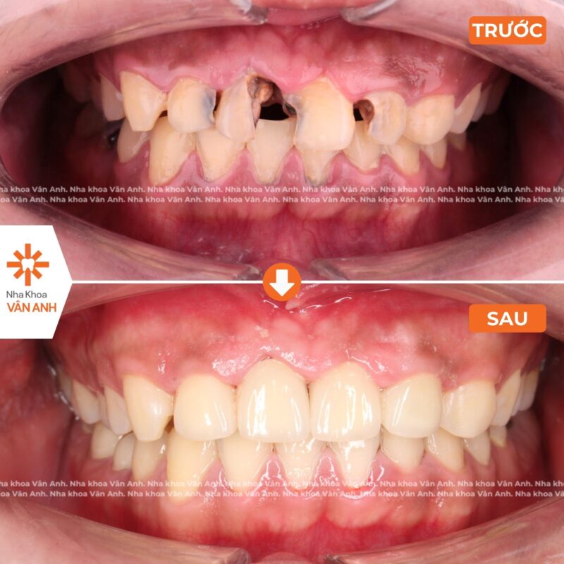 bọc răng sứ nha khoa vân anh