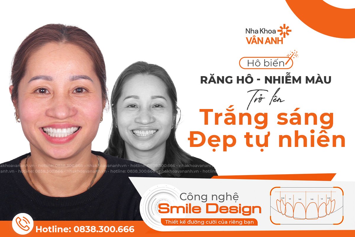 bọc răng sứ nha khoa vân anh 6