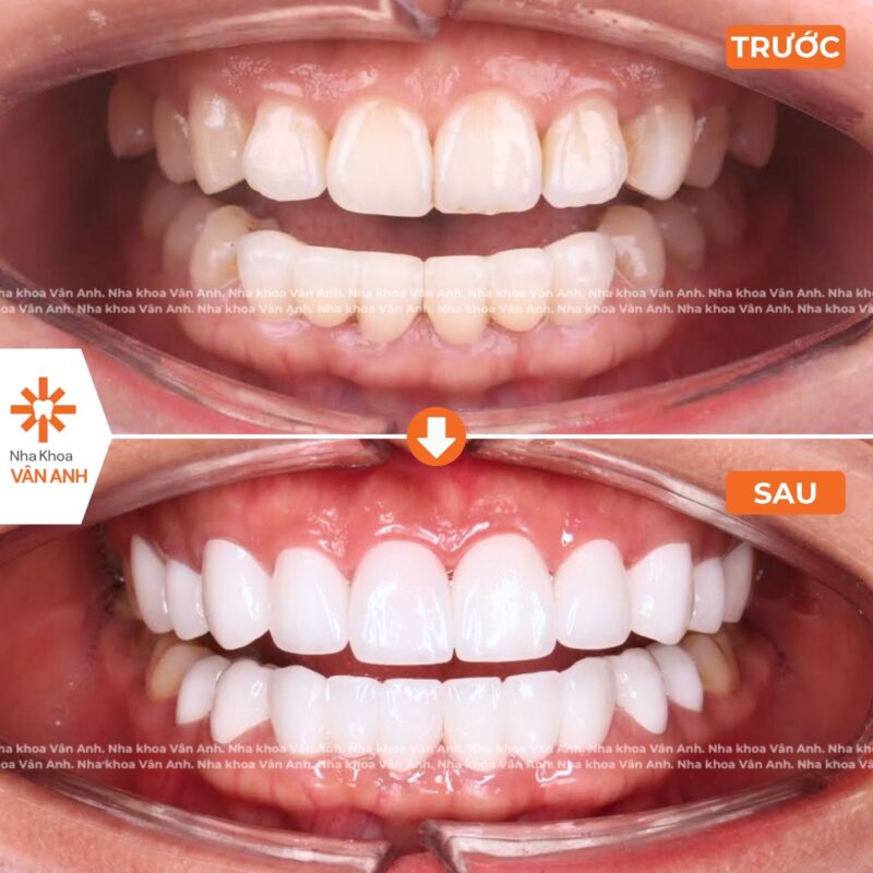 bọc răng sứ nha khoa vân anh