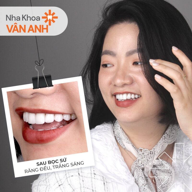 bọc răng sứ nha khoa vân anh 6