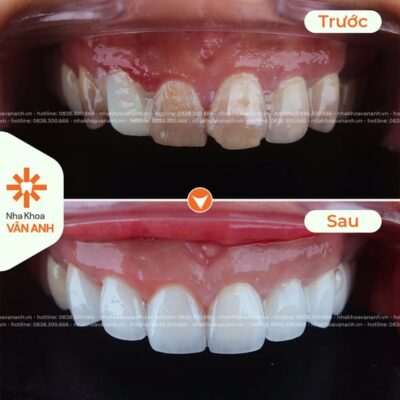 bọc răng sứ nha khoa vân anh