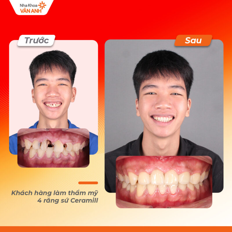 bọc răng sứ nha khoa vân anh