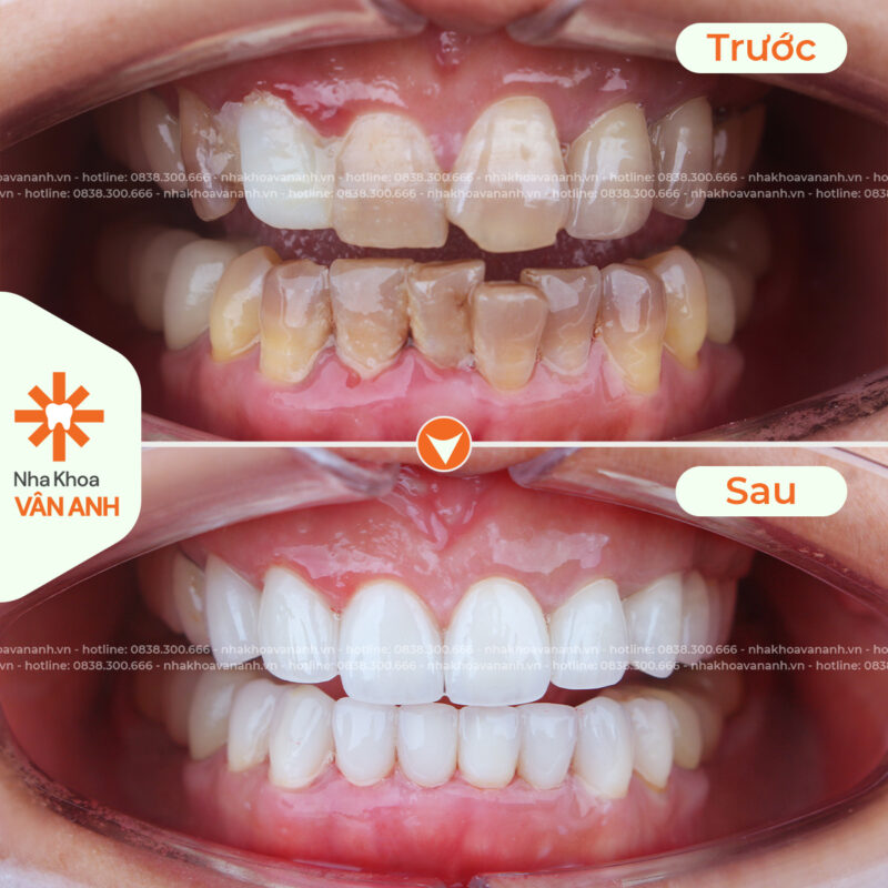 bọc sứ nha khoa vân anh 7