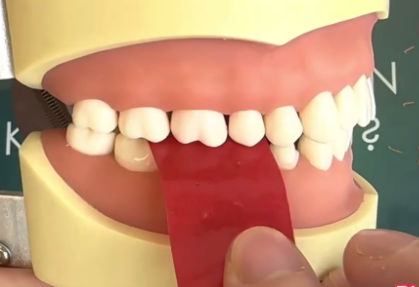 mài chỉnh khớp cắn răng sứ