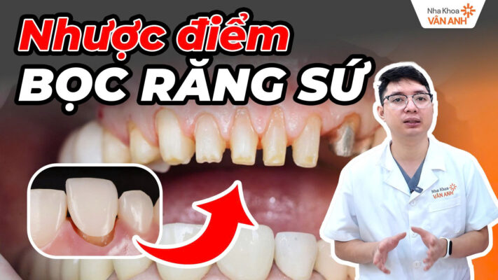 nhược điểm bọc răng sứ