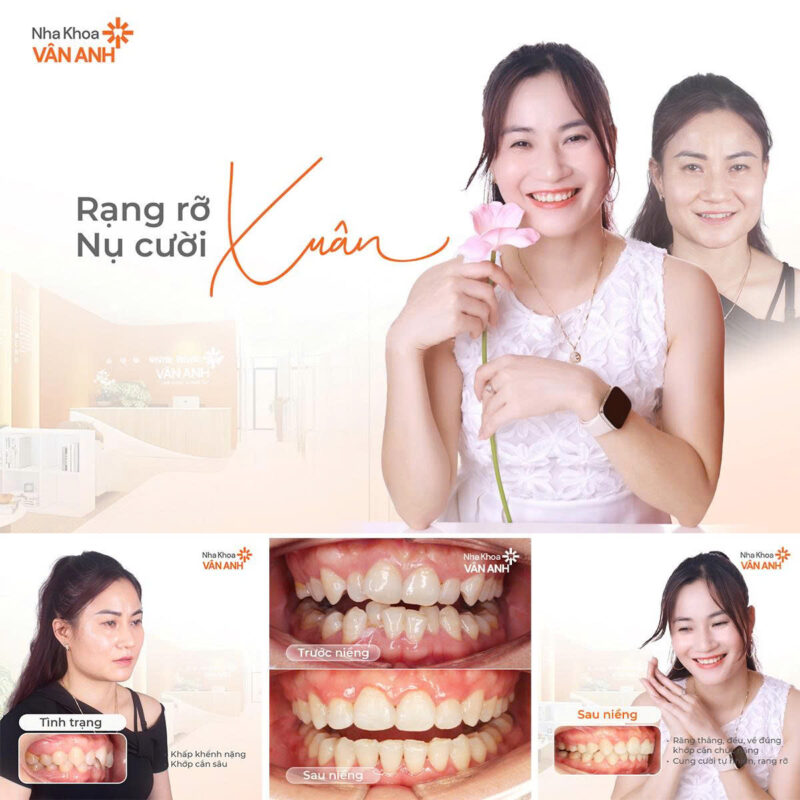 niềng răng nha khoa vân anh