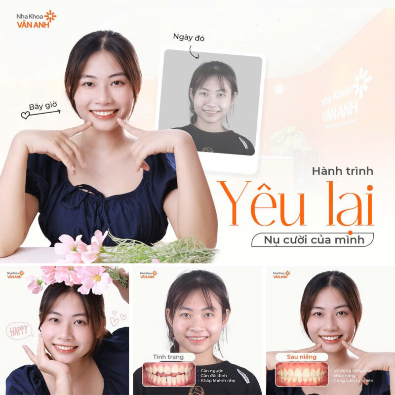 niềng răng nha khoa vân anh