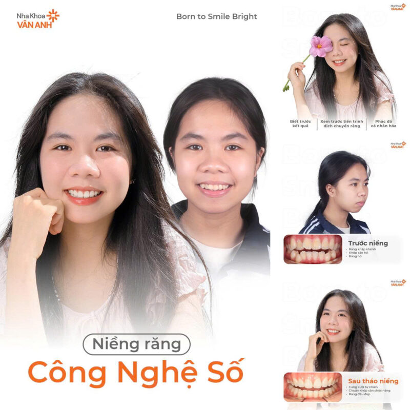 niềng răng nha khoa vân anh